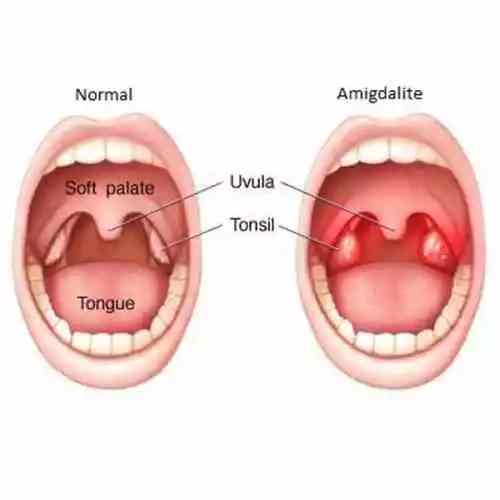 Como tratar a amigdalite com homeopatia?