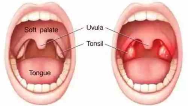 Como tratar a amigdalite com homeopatia? 