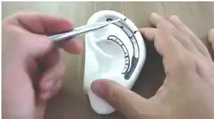 13 Escafoide