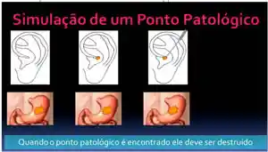 2 Ponto Patologico