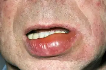 angioedema