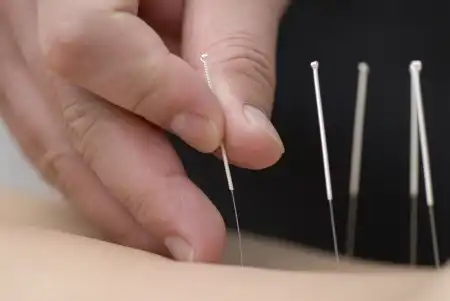 agulhas de acupuntura