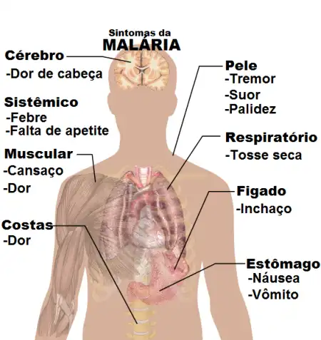 malaria sintomas