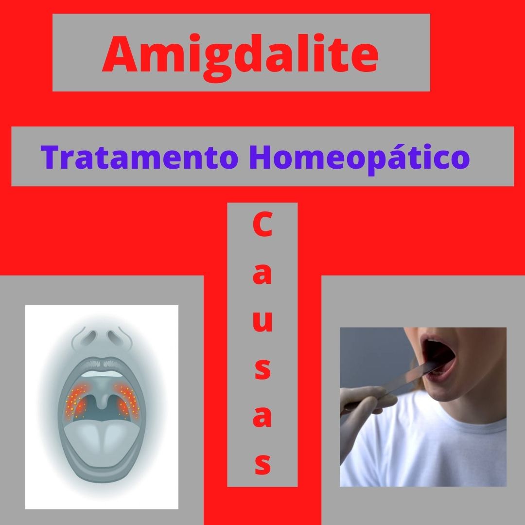 Amigdalite 2